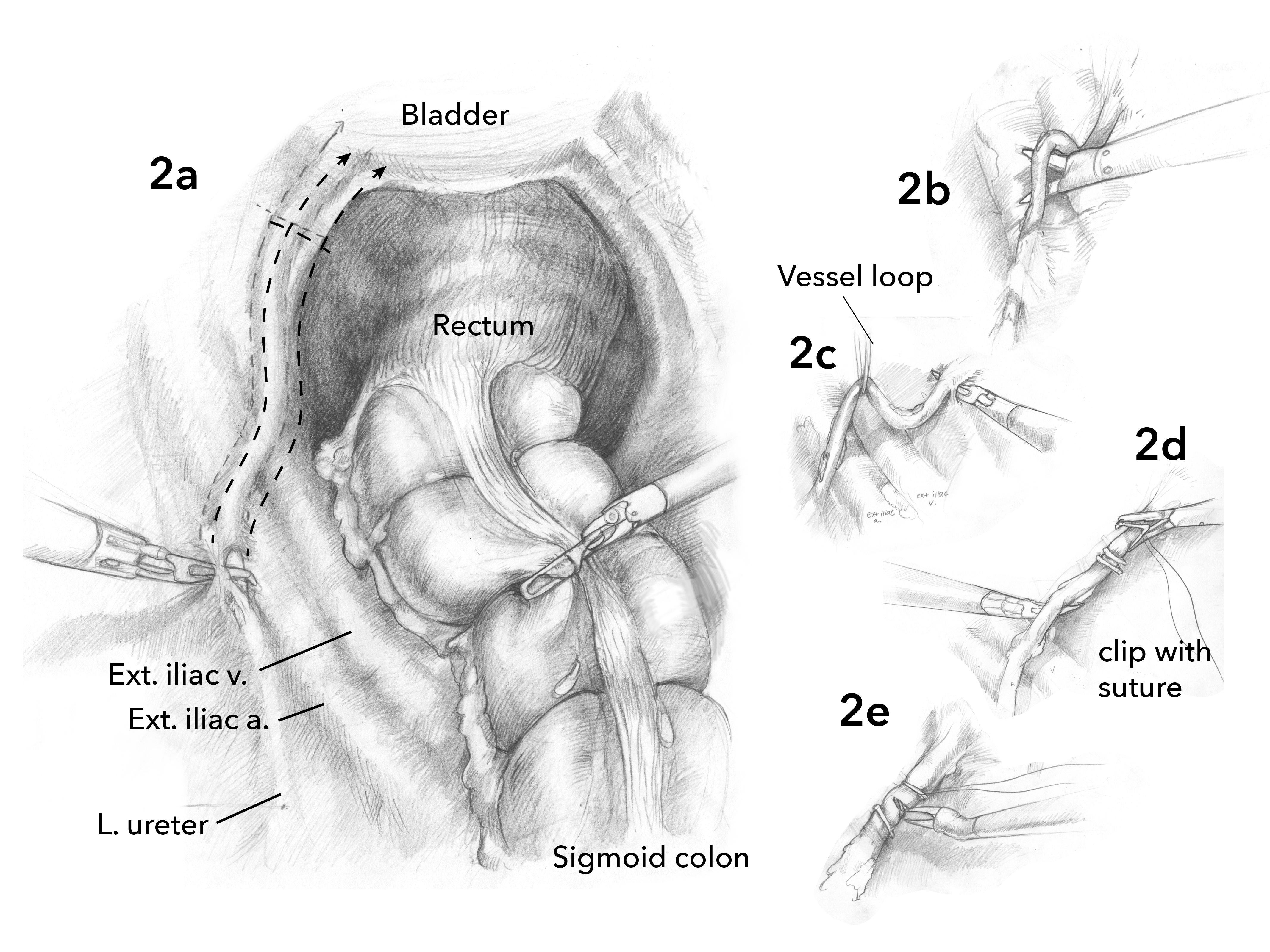 Picture describing two-trocar laparoscopic appendectomy. The appendix... |  Download Scientific Diagram